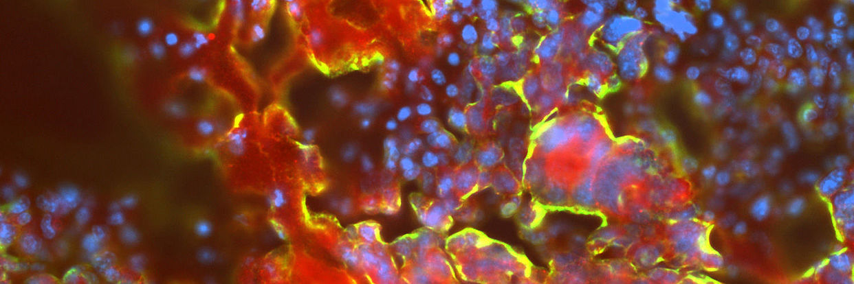 Leuchtend gelb erscheinen die tief im Gehirn liegenden Hirntumorzellen, blau ihre Zellkerne und rot und grün zwei Oberflächenantigene. 